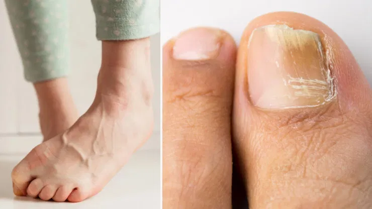What Are White Spots On My Toenails?