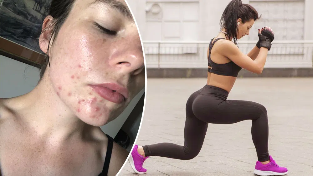 Does Exercise Help Acne?