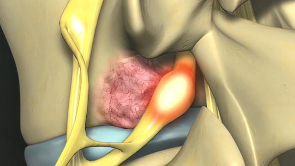 Effective Exercises For Shoulder Impingement