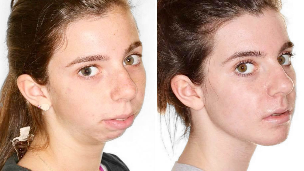 Get a Defined Jawline: Top Jawline Exercises For A Sculpted Look