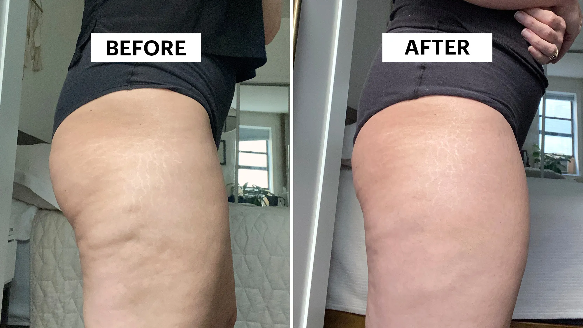 Aveli ceullite treatment before after 1