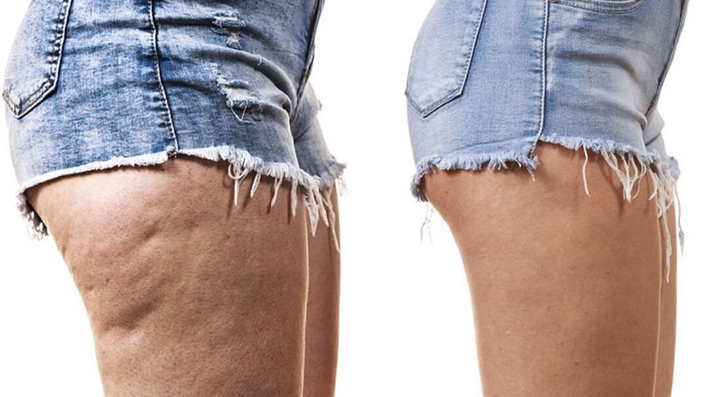 Can You Get Rid Of Cellulite With Exercise?