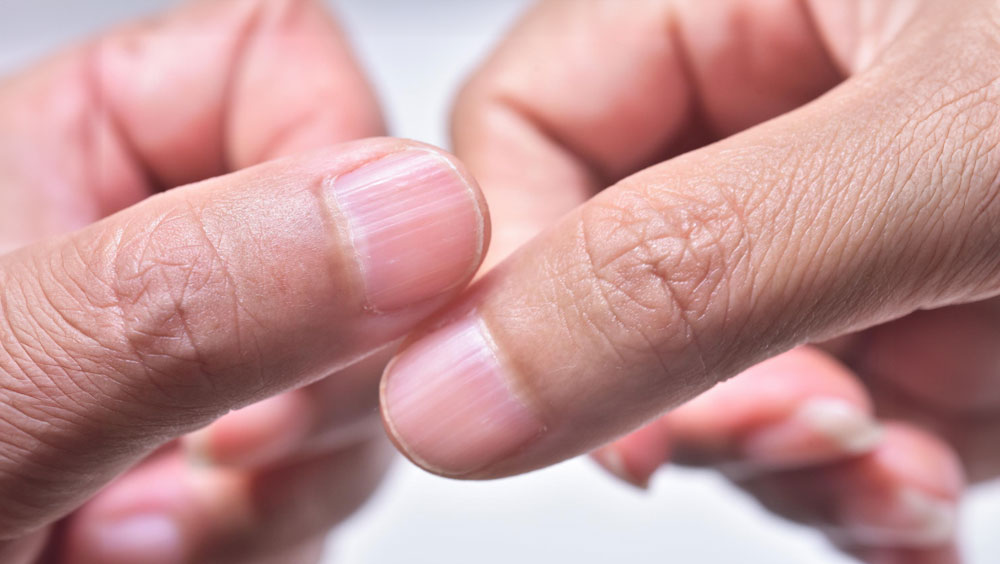 What Causes Fingernail Ridges