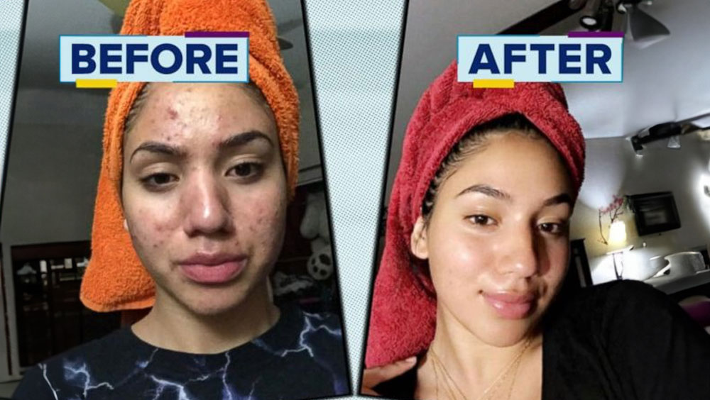 Does Exercise Help Acne?